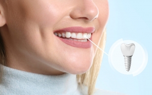 10 Unique Benefits of Dental Implants